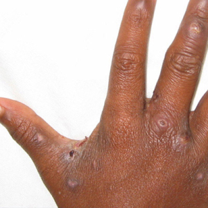 Scabies treatment with tablets